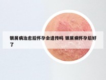 银屑病治愈后怀孕会遗传吗 银屑病怀孕后好了
