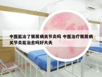 中医能冶了银屑病关节炎吗 中医治疗银屑病关节炎能治愈吗好大夫