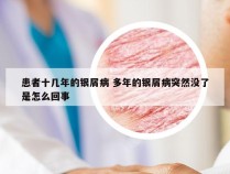患者十几年的银屑病 多年的银屑病突然没了是怎么回事