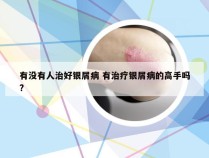 有没有人治好银屑病 有治疗银屑病的高手吗?