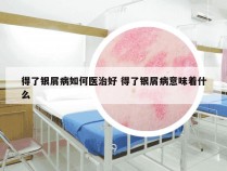 得了银屑病如何医治好 得了银屑病意味着什么