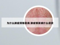 为什么脚底得银屑病 脚底银屑病什么症状