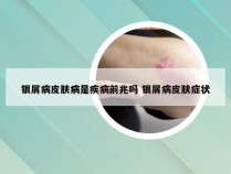 银屑病皮肤病是疾病前兆吗 银屑病皮肤症状