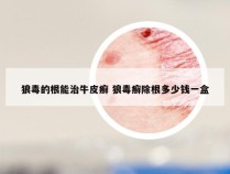 狼毒的根能治牛皮癣 狼毒癣除根多少钱一盒