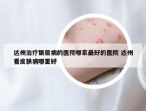 达州治疗银屑病的医院哪家最好的医院 达州看皮肤病哪里好