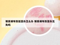银屑病导致低蛋白怎么办 银屑病导致蛋白流失吗
