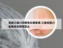 皮肤三维ct诊断龟头银屑病 三维皮肤ct能确定白斑类型么