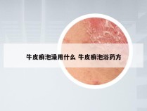牛皮癣泡澡用什么 牛皮癣泡浴药方