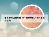 牛皮癣用过的东西 得牛皮肤癣的人拿的东西能吃吗