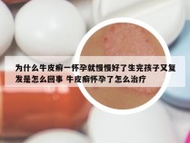 为什么牛皮癣一怀孕就慢慢好了生完孩子又复发是怎么回事 牛皮癣怀孕了怎么治疗