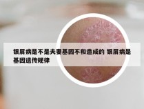 银屑病是不是夫妻基因不和造成的 银屑病是基因遗传规律