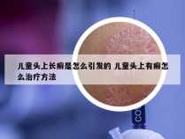 儿童头上长癣是怎么引发的 儿童头上有癣怎么治疗方法