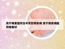 南宁哪里医院治寻常型银屑病 南宁银屑病医院哪里好