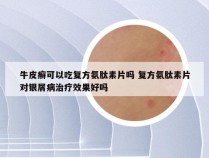 牛皮癣可以吃复方氨肽素片吗 复方氨肽素片对银屑病治疗效果好吗