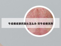 牛皮癣皮肤抗氧化怎么办 抗牛皮癣洗剂