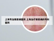 上海专治银屑病医院 上海治疗银屑病的专科医院