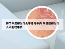 得了牛皮癣为什么不能吃牛肉 牛皮肤癣为什么不能吃牛肉