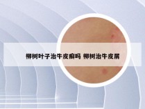 柳树叶子治牛皮癣吗 柳树治牛皮屑