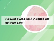 广州牛皮癣老中医祖传秘方 广州看银屑病最好的中医院是哪家?