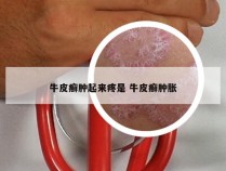 牛皮癣肿起来疼是 牛皮癣肿胀
