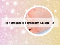 腿上起银屑病 腿上起银屑病怎么好的快一点