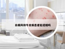 白癜风和牛皮癣患者能结婚吗