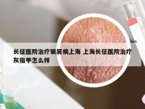 长征医院治疗银屑病上海 上海长征医院治疗灰指甲怎么样