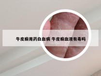 牛皮癣用药白血病 牛皮癣血液有毒吗