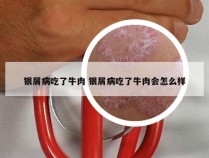 银屑病吃了牛肉 银屑病吃了牛肉会怎么样