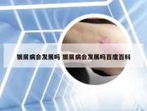 银屑病会发展吗 银屑病会发展吗百度百科