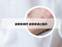 副银屑病钙 副银屑病口服药
