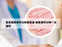 患有银屑病可以和葡萄酒 银屑病可以喝一点酒吗