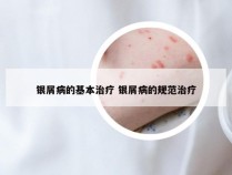 银屑病的基本治疗 银屑病的规范治疗