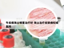 牛皮癣海口哪里治疗好 海口治疗皮肤病权威医院