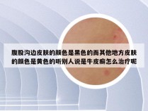 腹股沟边皮肤的颜色是黑色的而其他地方皮肤的颜色是黄色的听别人说是牛皮癣怎么治疗呢