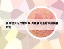 青黛软膏治疗银屑病 青黛软膏治疗银屑病有效吗
