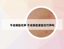 牛皮癣能吃笋 牛皮癣患者能吃竹笋吗