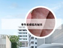 寻牛皮癣验方秘方