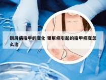 银屑病指甲的变化 银屑病引起的指甲病变怎么治