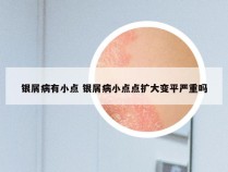 银屑病有小点 银屑病小点点扩大变平严重吗