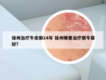 徐州治疗牛皮癣14年 徐州哪里治疗银牛屑好?
