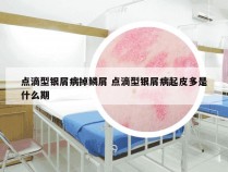 点滴型银屑病掉鳞屑 点滴型银屑病起皮多是什么期