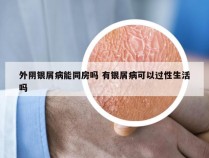 外阴银屑病能同房吗 有银屑病可以过性生活吗