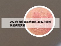 2023年治疗银屑病消息 2021年治疗银屑病新突破