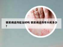 银屑病遗传能治好吗 银屑病遗传率大概多少?