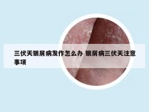 三伏天银屑病发作怎么办 银屑病三伏天注意事项