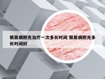 银屑病照光治疗一次多长时间 银屑病照光多长时间好