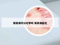 银屑病可以吃枣吗 银屑病能吃