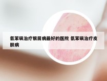 氨苯砜治疗银屑病最好的医院 氨苯砜治疗皮肤病