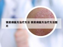 银屑病偏方治疗方法 银屑病偏方治疗方法图片